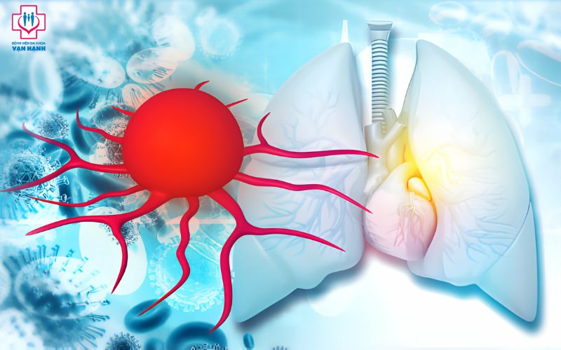 Các loại ung thư phổi: nguyên nhân và dấu hiệu nhận biết